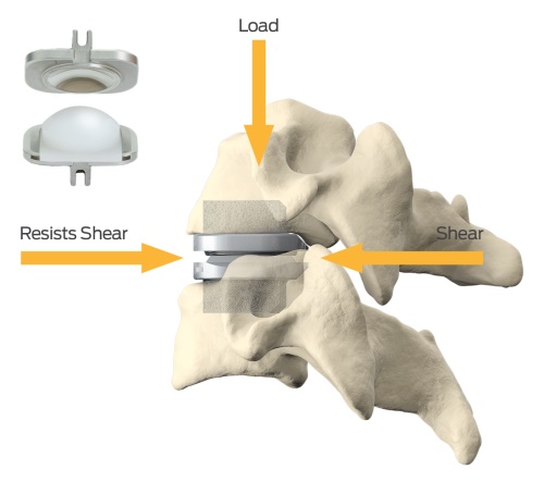 Oregon Spine Care -Artificial Disc Replacement