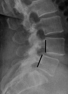 Spondylolisthesis